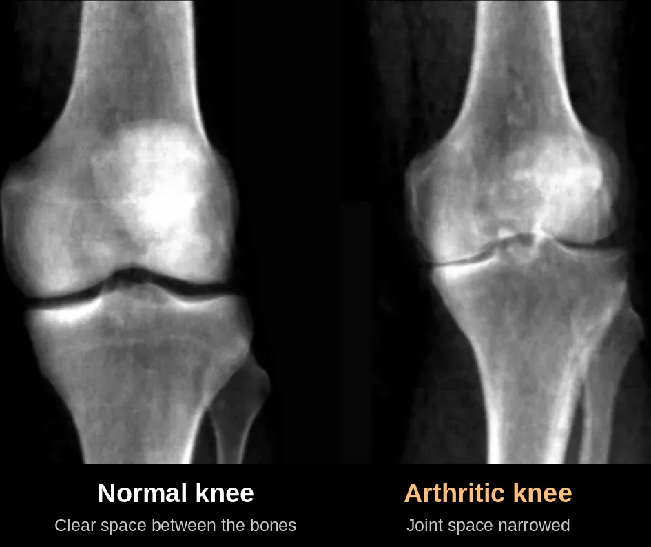 X-ray comparison of a normal knee and an arthritic knee
